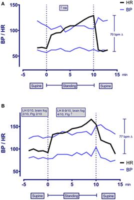 Adolescent and Young Adult ME/CFS After Confirmed or Probable COVID-19